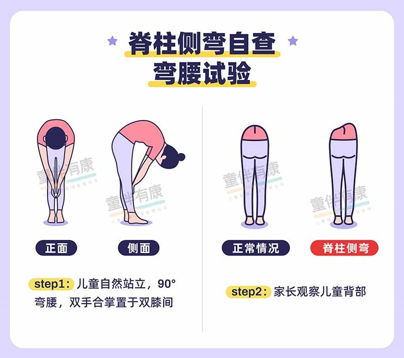 脊柱侧弯2-800.jpg