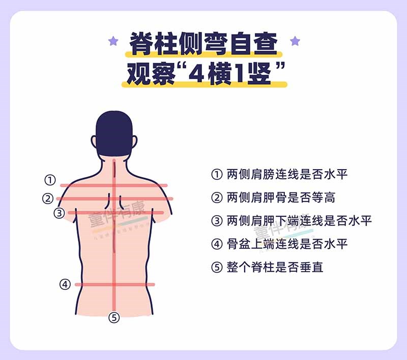 脊柱侧弯1-800.jpg