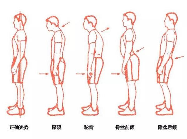 不良体态.jpeg